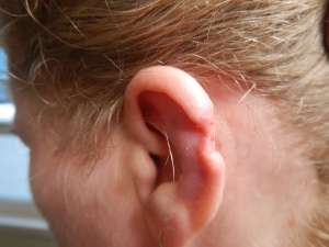 my left ear, stitches removed.
