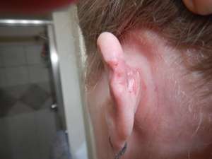 my left ear, stitches removed.